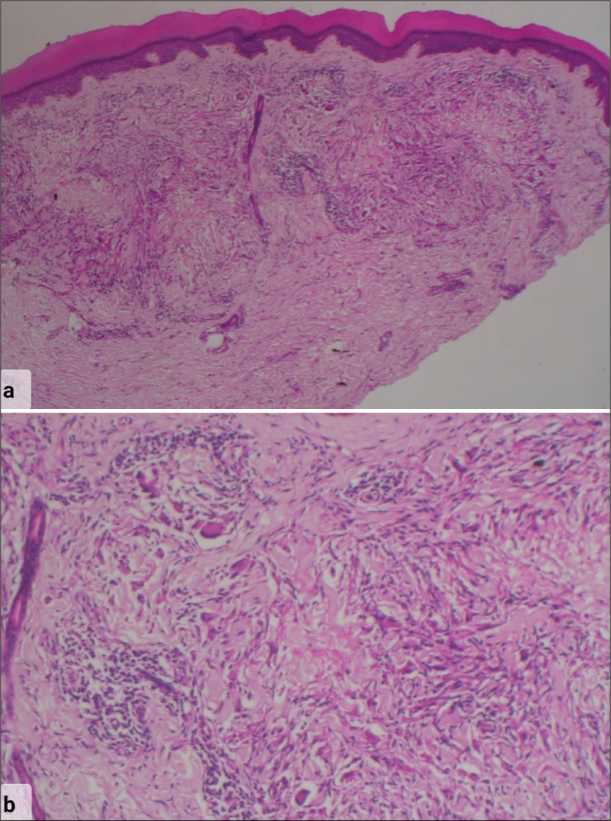 Histopathology photomicrograph stained with hematoxylin and eosin stain showing (a) normal epidermis with a palisading granuloma in mid reticular dermis around a focus of mucin deposition and incomplete collagen degeneration. The rest of the dermis shows a sparse superficial and deep perivascular lymphocytic infiltrate (×10 Low-power magnification) (b) The granuloma consists of lymphocytes, histiocytes, and occasional giant cells in a semicircular palisade around central mucin deposition and necrobiosis (×40 High-power magnification).