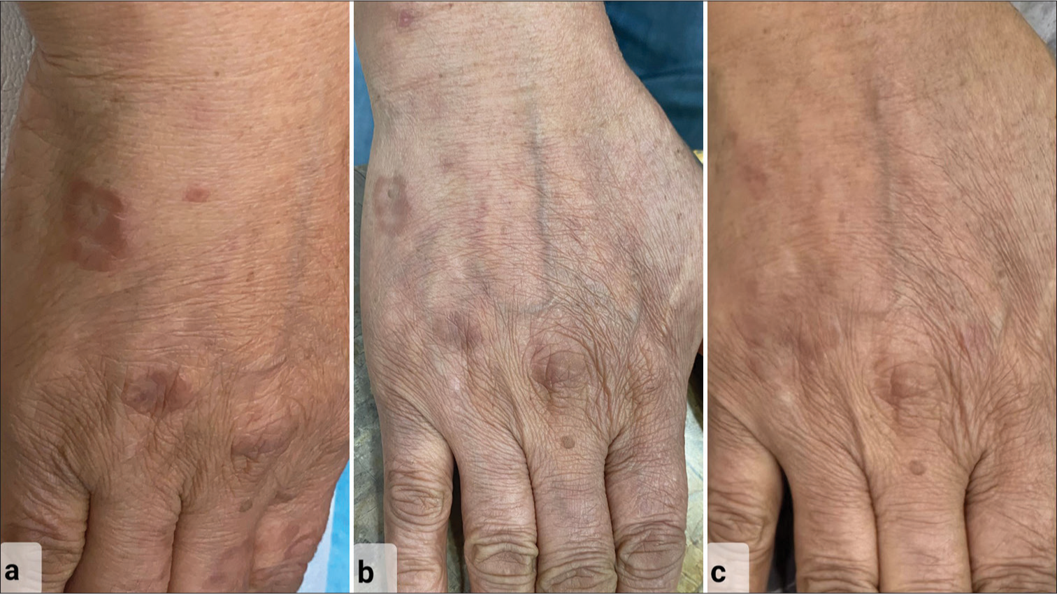 Clinical pictures showing improvement over dorsum of the right hand of patient with (a) classical erythematous annular papules and plaques at presentation, (b) partial resolution after treatment initiation with tofacitinib at 3-month follow-up with decrease in erythema and flattening of skin lesions, and (c) complete resolution of skin lesions with no sequelae as seen at 2-year follow-up.