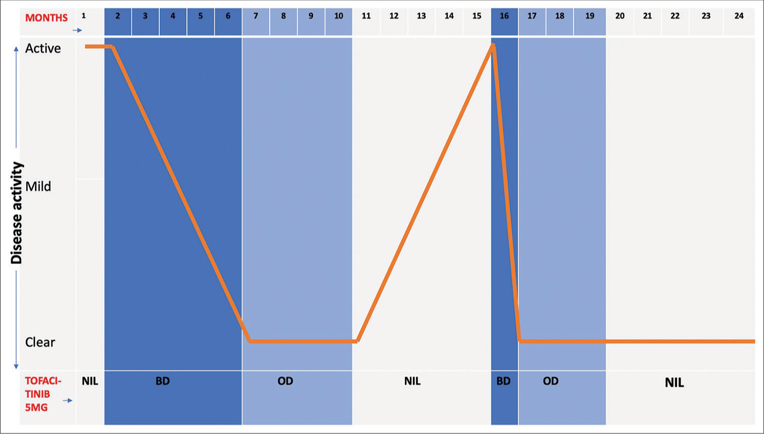 Graphical representation of clinical history summary showing treatment given to patient corresponding with disease activity and response over 2 years. OD: Once daily, BD: Twice daily.