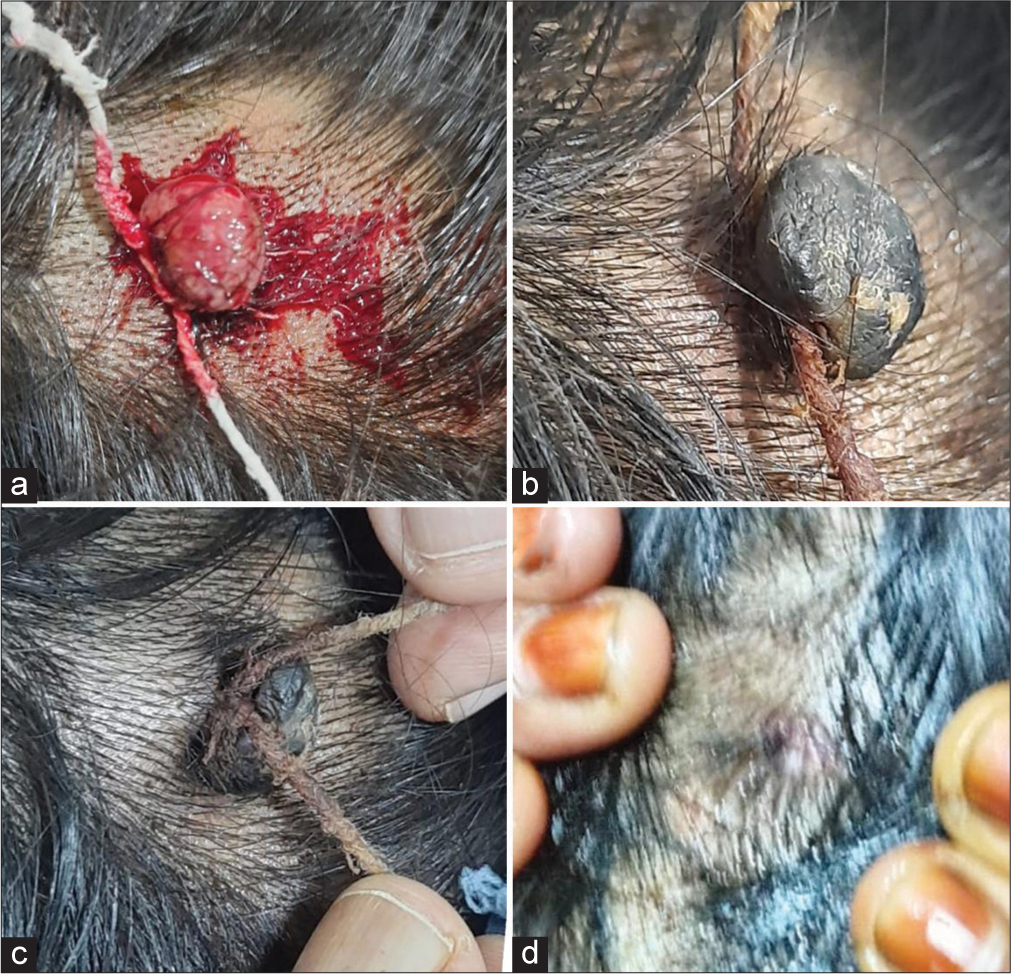 (a-d) The ligation of the excoriated hemorrhagic granuloma pyogenicum on scalp and alterations in the lesion and at the site after 10 days.