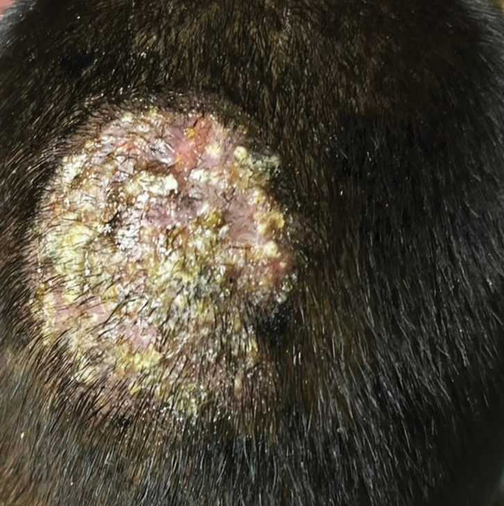 Well-defined boggy swelling studded with pustules and crusting on central scalp.