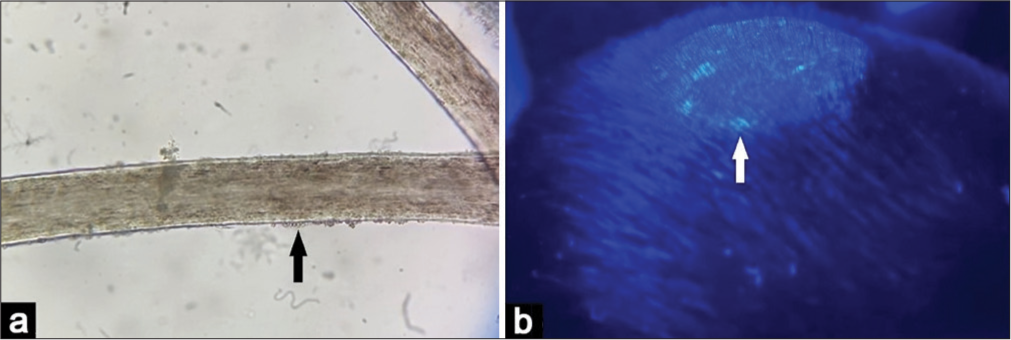 (a) Hair microscopy showing spores on the shaft (arrow) suggestive of ectothrix, potassium hydroxide ×100, (b) Wood’s lamp examination showing bright green fluorescence suggestive of Microsporum species (arrow).