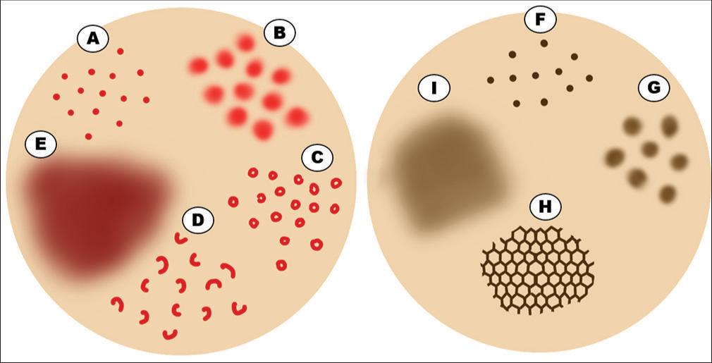 Diagrammatic representation of dermoscopic features of pigmented purpuric dermatosis. (A) Red dots. (B) Red globules. (C) Red circles. (D) Comma-like vessels. (E) Coppery-red background. (F) Brown dots. (G) Brown globules. (H) Accentuated pigment network. (I) Brown background.