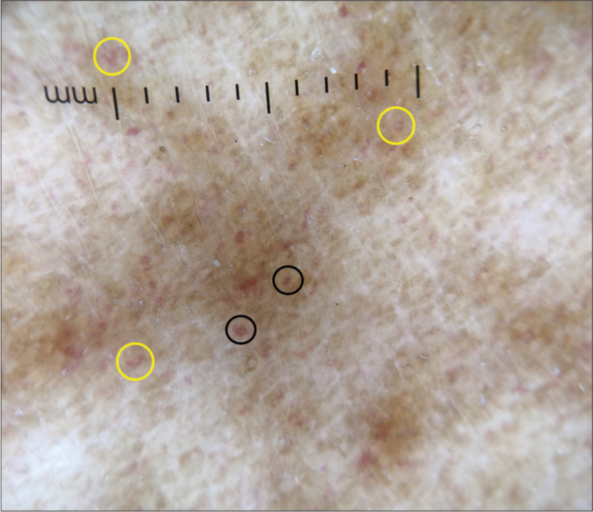 Dermoscopy (DermLite DL4; ×10) shows red dots (black circles), comma-like vessels (yellow circles), brown background with increased pigment network.