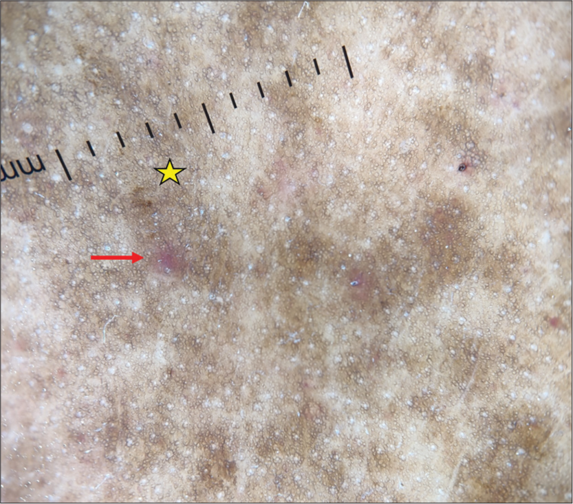 Dermoscopy (DermLite DL4; ×10) shows red globules (red arrow), increased pigment network, and brown background (yellow star).