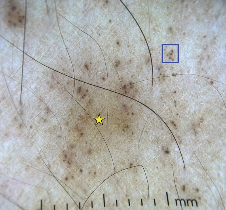 Dermoscopy (DermLite DL4; ×10) shows brown dots (blue square) and brown background (yellow star).