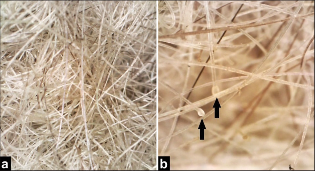 (a) Dermoscopy showing “tangled mesh of fiber optics,” Polarizing ×30, (b) “Bulb pipette” appearance (arrows), Polarizing ×80.