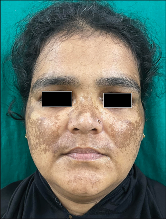 Clinical image of melasma.