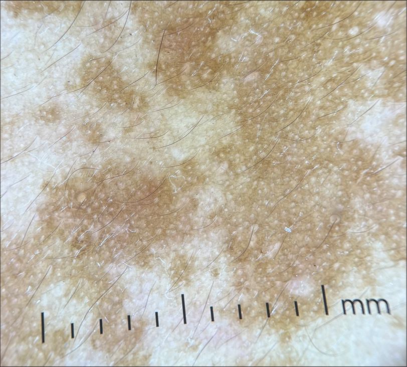 Dermoscopy of melasma (DermLite DL4, ×10, non-polarized) showing increased pseudoreticular pigment network with sparing of follicular and eccrine openings.