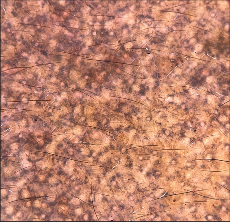 Dermoscopy of lichen planus pigmentosus (DermLite DL4, ×10, polarized) showing blue dots, gray dots.