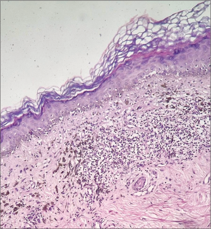 Histopathology in lichen planus pigmentosus (H&E, ×200) showing basal vacuolar degeneration and pigment incontinence in the dermis. H&E: Hematoxylin and eosin.