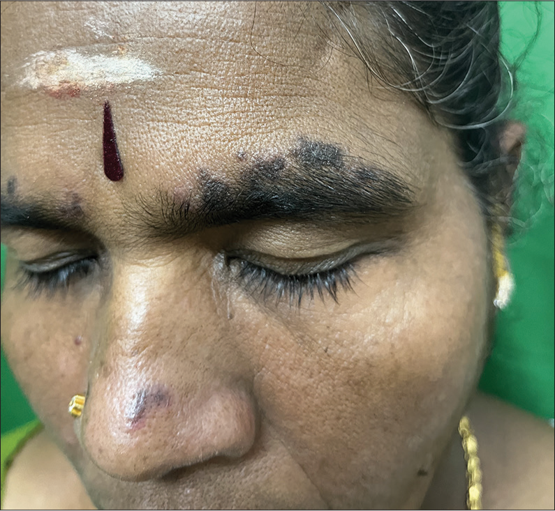 Clinical image of discoid lupus erythematosus.