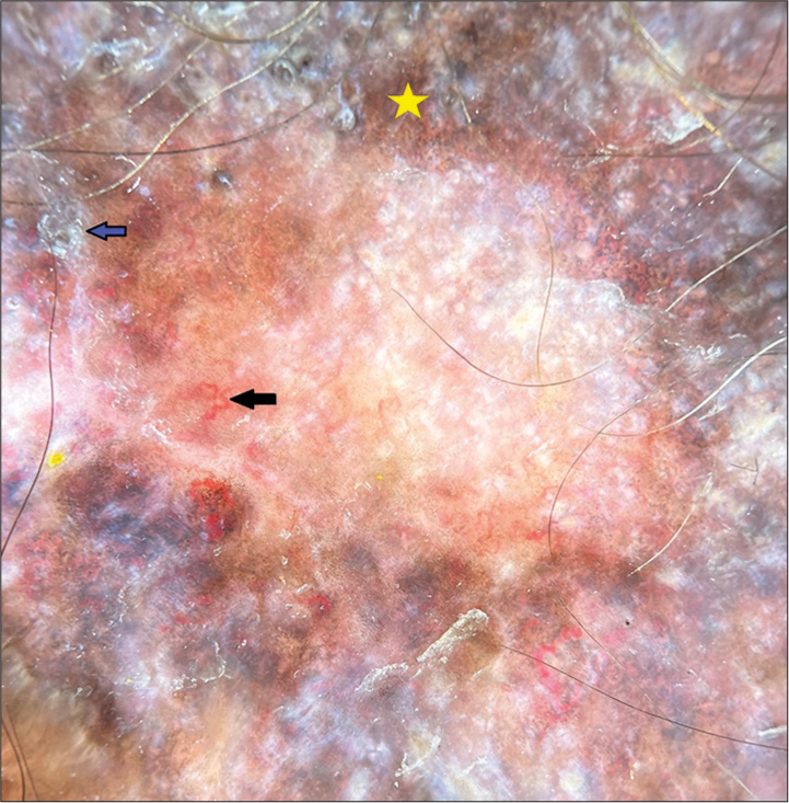 Dermoscopy of discoid lupus erythematosus (DermLite DL4, ×10, polarized) showing peripheral hyperpigmentation (yellow star), telangiectasia (black arrow), and scaling (blue arrow).