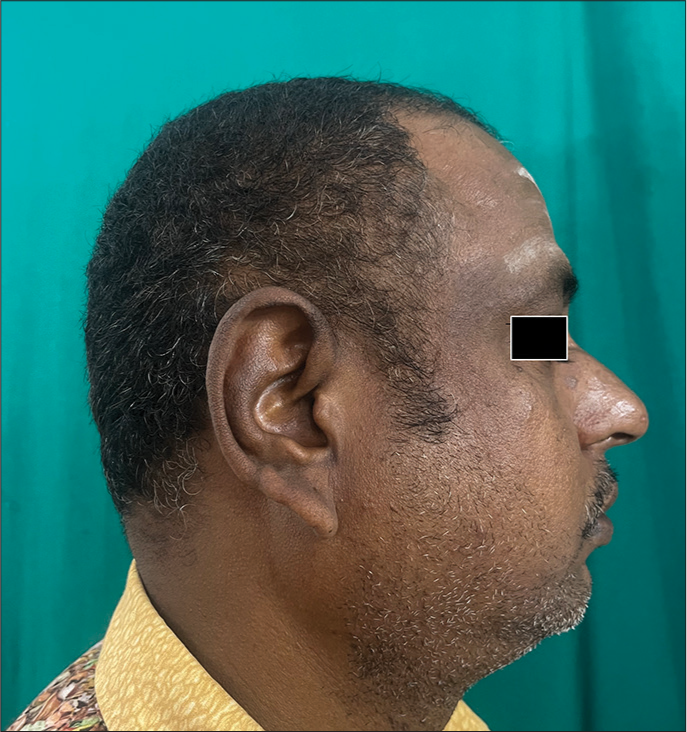 Clinical image of maturational dyschromia.