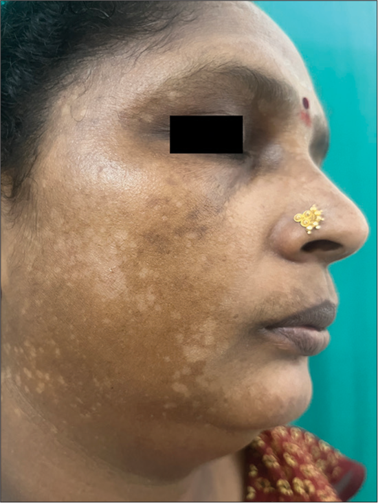 Clinical image of hypopigmented tinea versicolor.