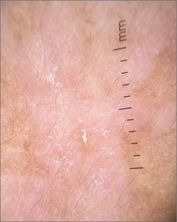 Dermoscopy in tinea versicolor (DermLite DL4, ×10, polarized) showing areas of decreased pigment network with overlying patchy scales.