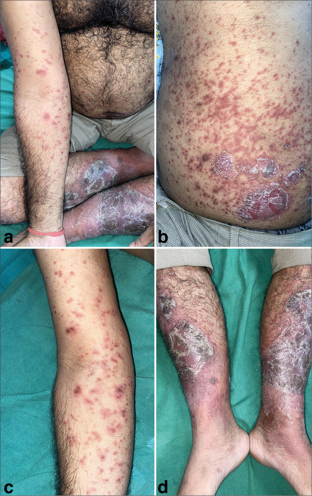 (a) Multiple well-defined erythematous indurated plaques approximately of size ranging from 4 × 5 cm to 6 × 7 cm with central loosely adherent silvery white scale over the elbow, lower abdomen, and bilateral lower limbs clinically diagnostic of plaque psoriasis. (b and c) Multiple annular erythematous to dusky papules and plaques of varying sizes with the center showing necrosis and peripheral rim of edema (targetoid morphology) suggestive of erythema multiforme such as pityriasis rosea over trunk, forearm, and back. (d) Over the bilateral lower limbs, the psoriatic plaques with surrounding erythema extending beyond the plaques. Over the erythematous base, multiple pus-filled lesions were observed with few of them merging to form a “lake of pus appearance.”