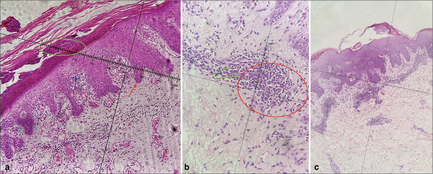 (a) Photomicrograph shows features of hyperkeratosis, acanthosis, parakeratosis, Munro’s microabscess (green circle), and suprapapillary thinning (blue arrow) and regular elongation of rete ridges (red arrow) suggestive of psoriasis (×40, H&E stain), (b) photomicrograph lymphocytic infiltration in the upper the dermis around dilated blood vessels (green arrow), and extravasated red blood cells (red circle) suggestive of pityriasis rosea (×40, H&E stain), and (c) Photomicrograph shows hyperkeratosis, irregular acanthosis, spongiosis, and parakeratoses with inflammatory infiltrate in dermis (×10, H&E stain). H&E: Hematoxylin and eosin.