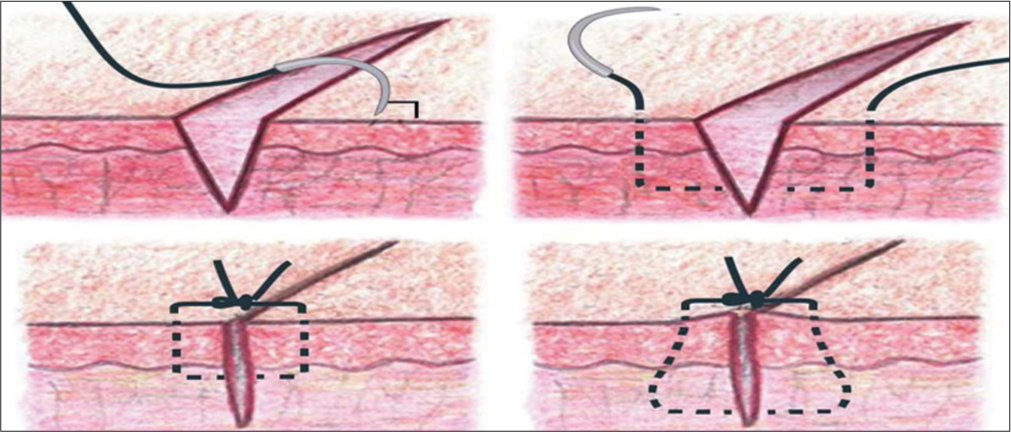 Simple interrupted sutures.