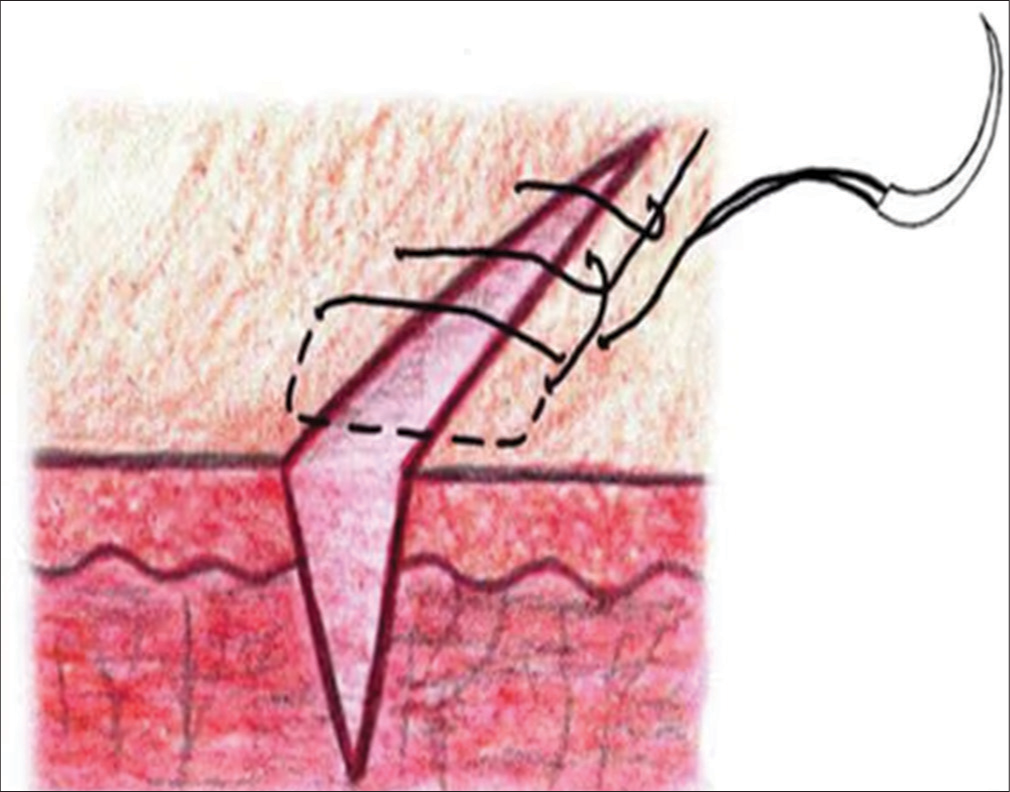 Running locked sutures.