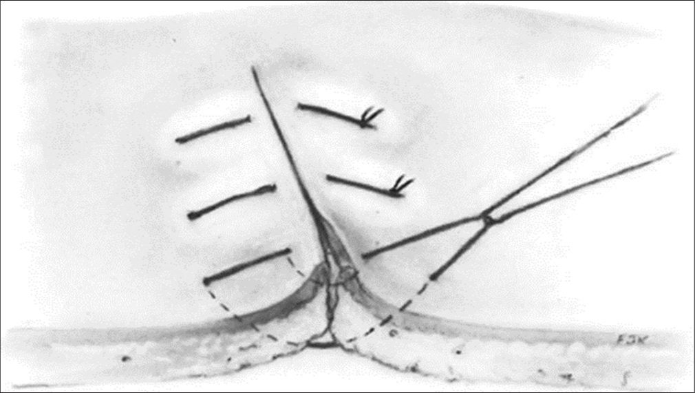 Vertical mattress sutures.