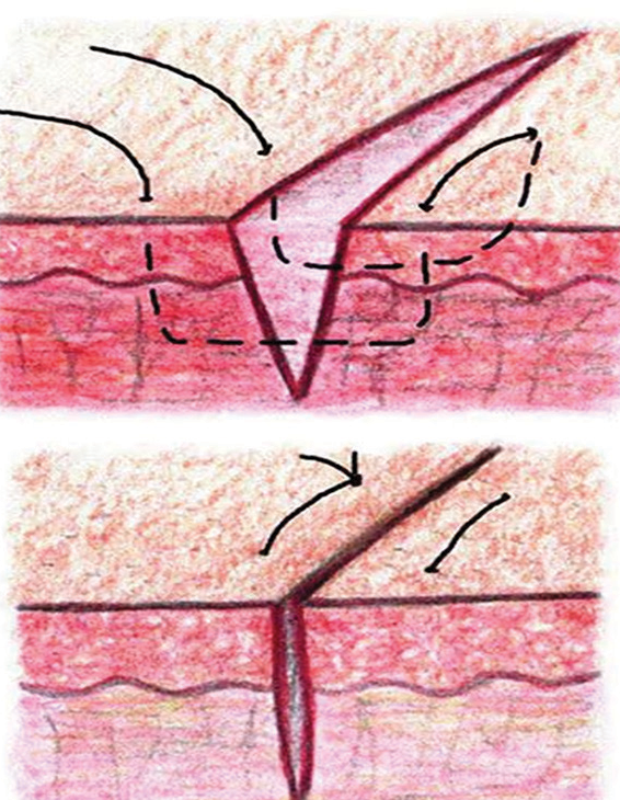 Horizontal mattress sutures.