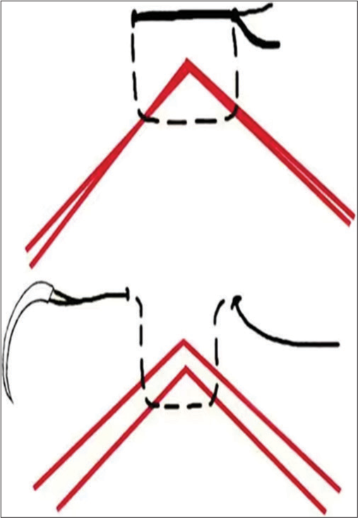 Modified half-buried horizontal mattress suture.