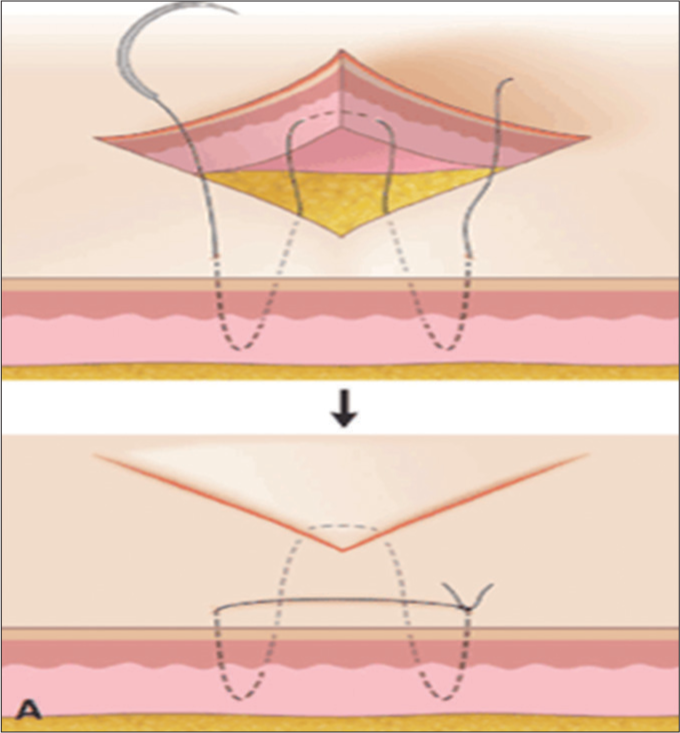 Deep tip stitch. Black arrow denotes after suturing.