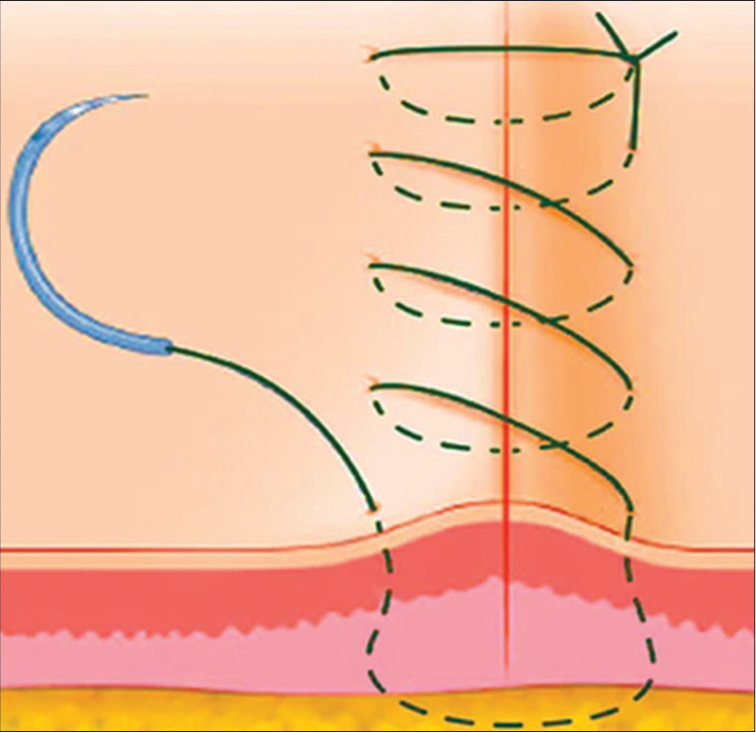 Running horizontal mattress sutures.