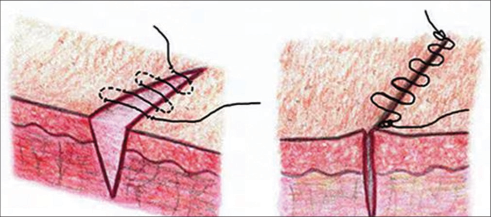 Running subcuticular sutures.