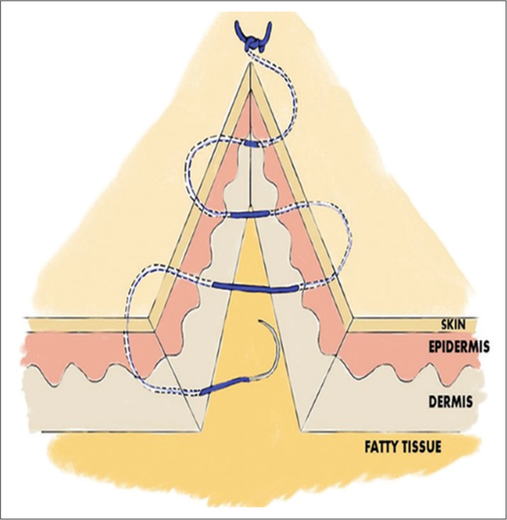 Running subcutaneous sutures.