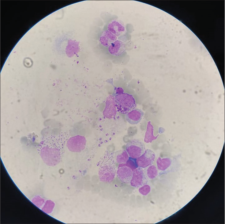 Leishman-Donovan bodies on Giemsa’s stain following slit-skin smear. Stain used: Giemsa; Magnification: ×4.