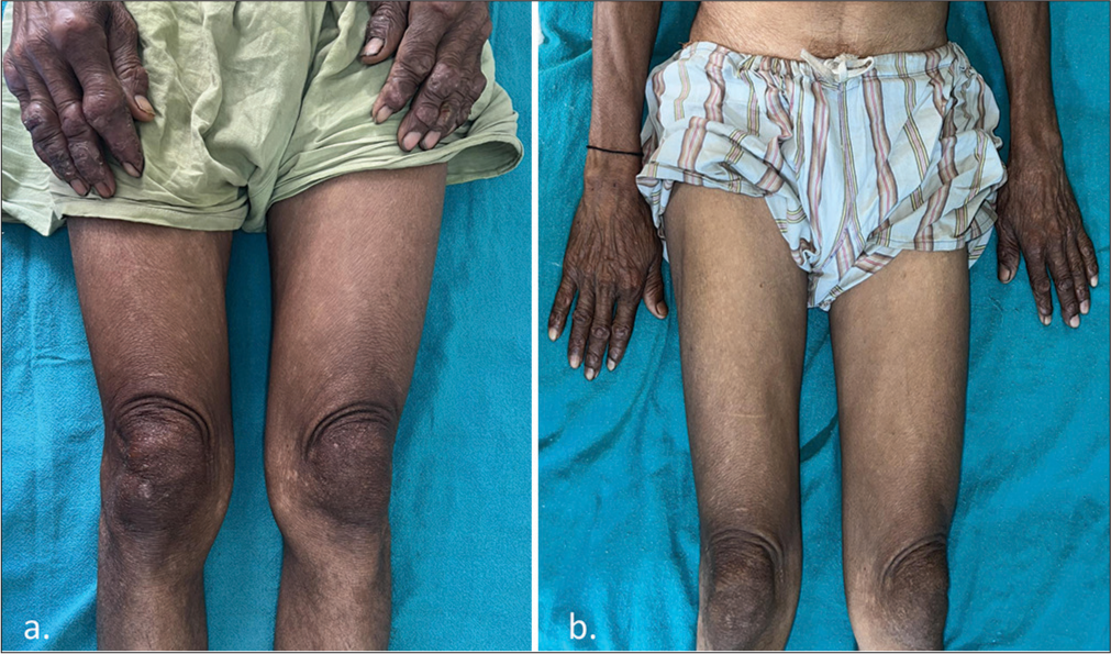 (a) Baseline picture showing nodular lesions over the hands and hypopigmented macules over the thighs. (b) Complete resolution of nodular lesions with partial improvement in the hypopigmented macules over the thigh.