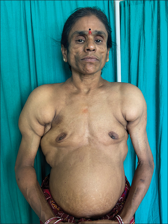 Bilateral breast hypoplasia with abnormal deposition of fat over the shoulder.