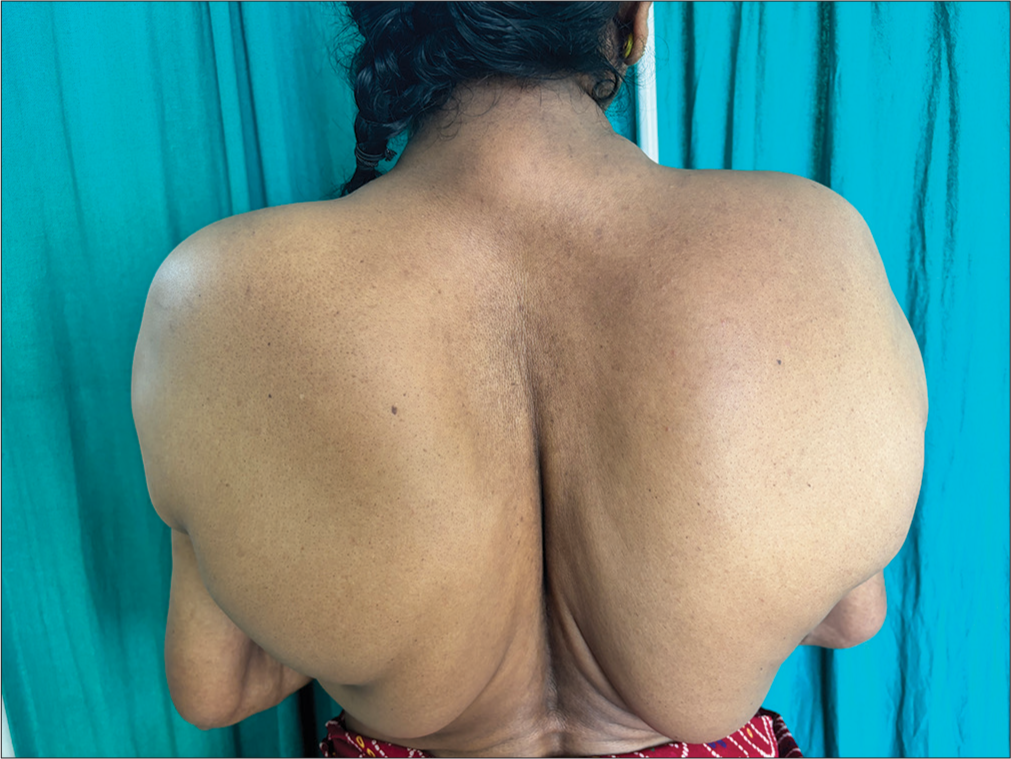 Abnormal deposition of fat over the scapula.