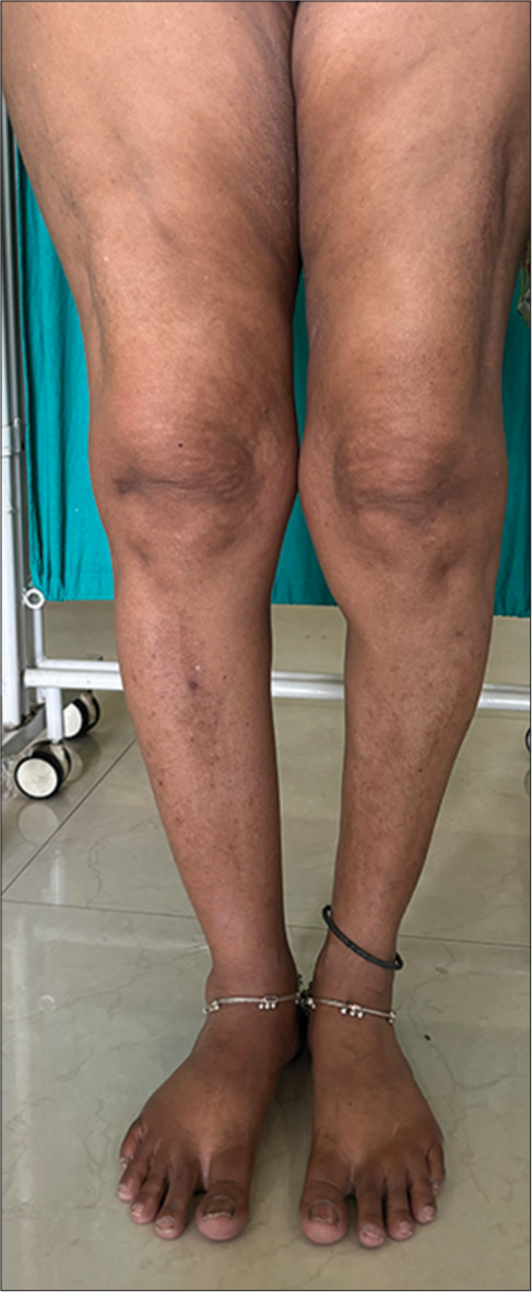 Normal distribution of fat over bilateral lower limb.