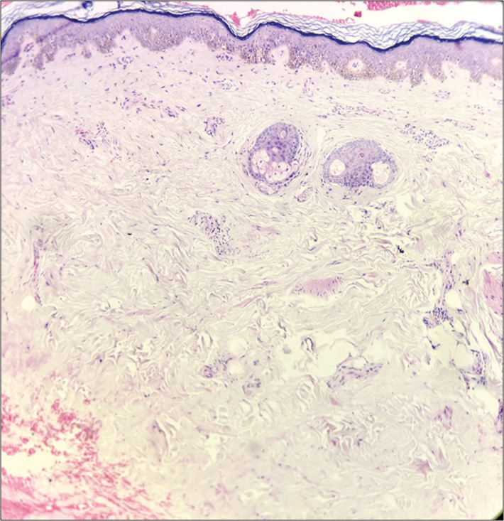 Histopathological analysis (hematoxylin and eosin ×10) revealed mild orthokeratosis, thinning of the epidermis accompanied by vacuolar degeneration in the basal layer, and a reduction in adipocyte lobules within the subcutaneous layer.