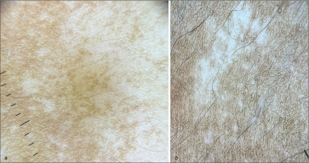 (a) Dermoscopy of the larger hypopigmented patch revealed a subtle broken pigment network with feathery margins suggestive of nevus depigmentosus. DermLite 4, Polarized mode, Magnification ×10. (b) Dermoscopy of smaller hypopigmented lesions showing diffuse whitish irregular area without scales suggestive of ash-leaf macules. DermLite 4, Polarized mode, Magnification ×10.