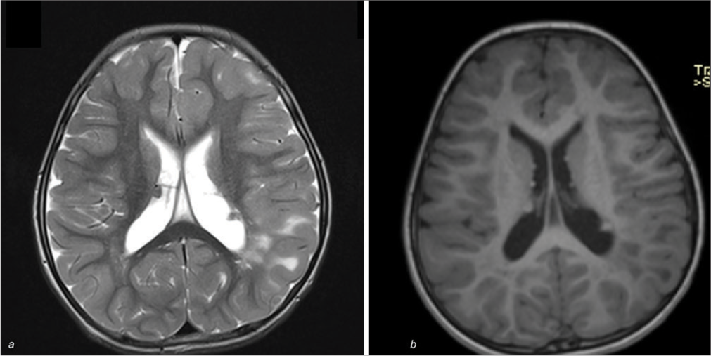 (a and b) Magnetic resonance imaging of the brain showing subependymal nodules in the periventricular area on T2 and T1-weighted images.