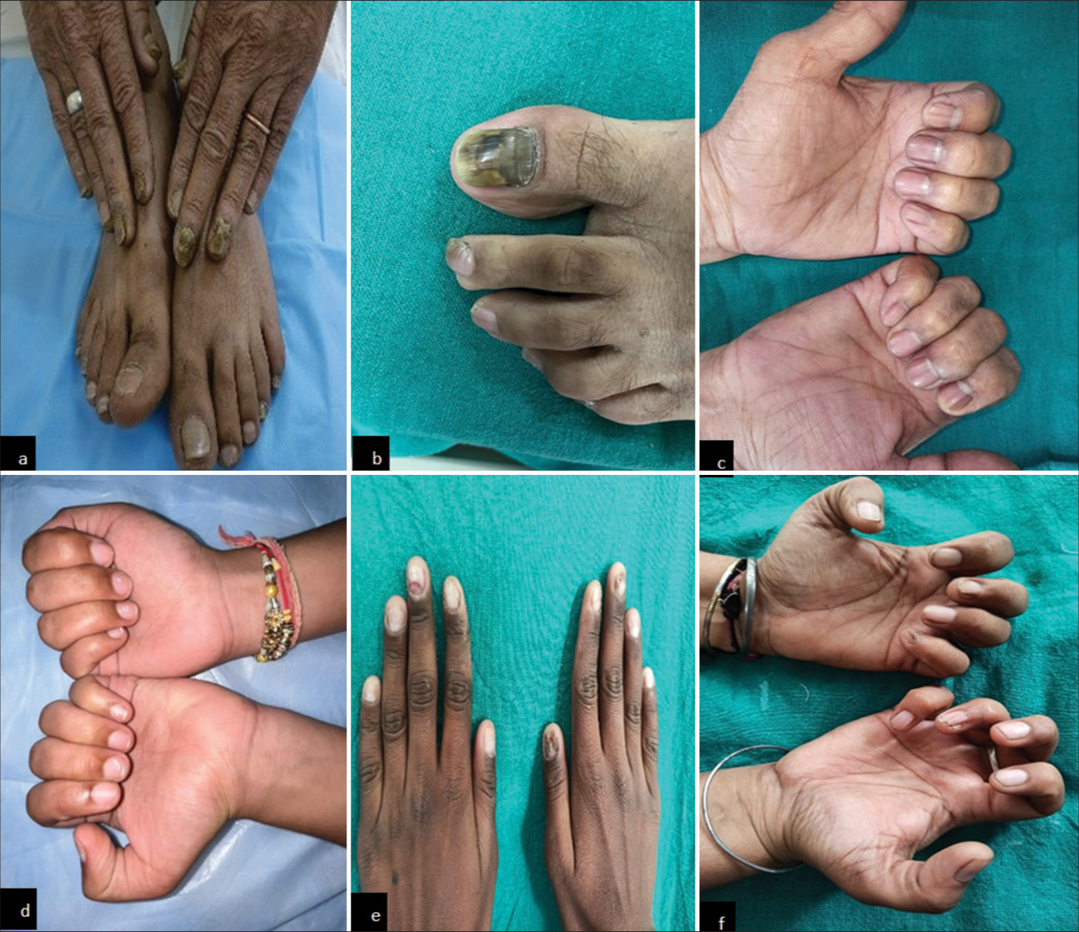 Clinical findings in diabetes mellitus patients. (a) Showing onychomycosis (fingernails), (b) Showing onychomycosis (toenails), (c) Showing melanonychia (fingernails), (d) Showing leukonychia (fingernails), (e) Showing onychodystrophy (fingernails), and (f) Showing pterygium (fingernails).