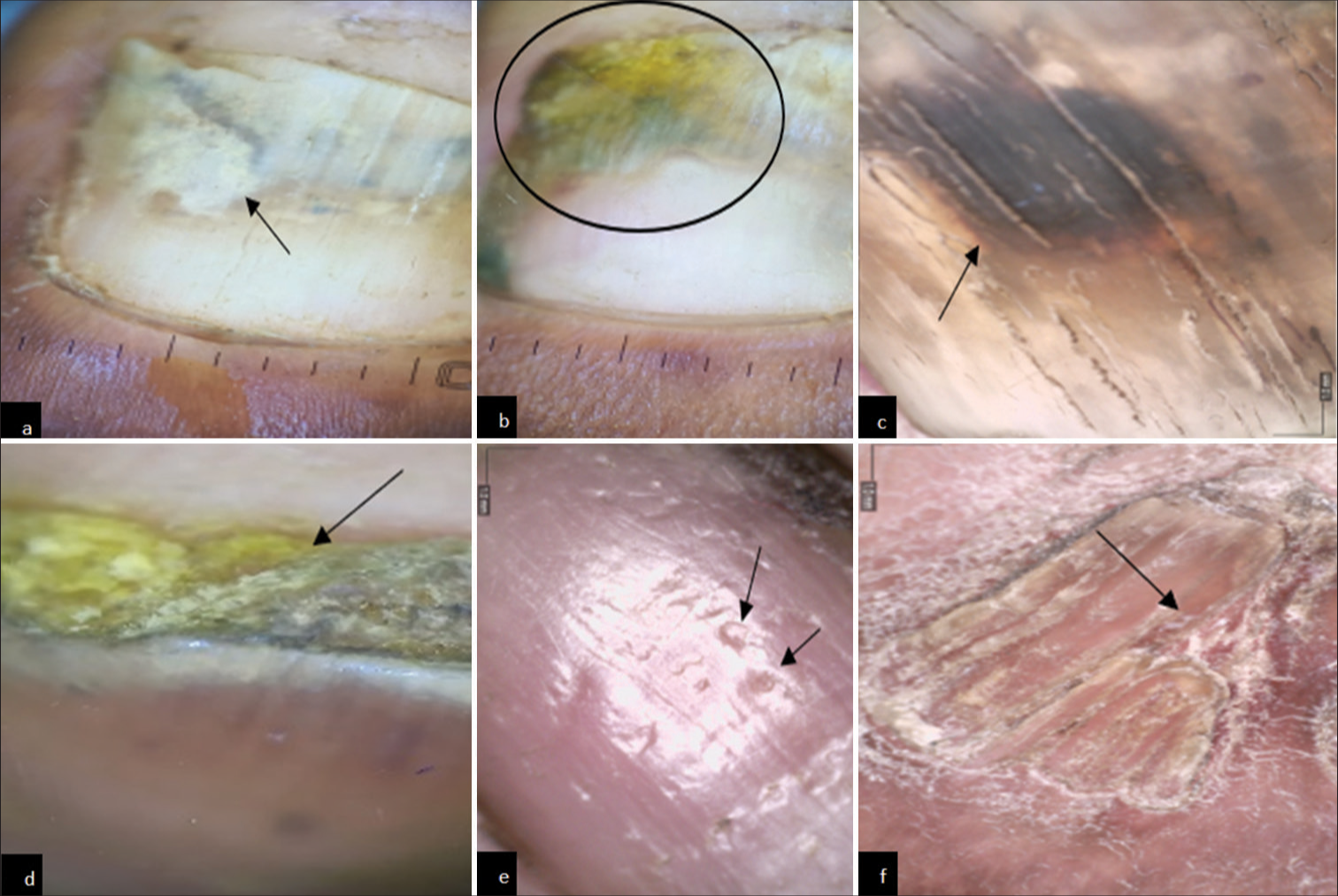 Onychoscopic findings in diabetes mellitus patients. (a) Onychoscopy showing onychomycosis. (Onycholysis with jagged edge with spikes) (black arrow). (b) Onychoscopy showing onychomycosis (distal lateral subungual). (Yellow discoloration and spikes and onycholysis) (black circle). (c) Onychoscopy showing onychomycosis. (black discoloration) (black arrow). (d) Onychoscopy showing subungual hyperkeratosis (black arrow). (e) Onychoscopy showing pitting (black arrow). (f) Onychoscopy showing pterygium (black arrow).