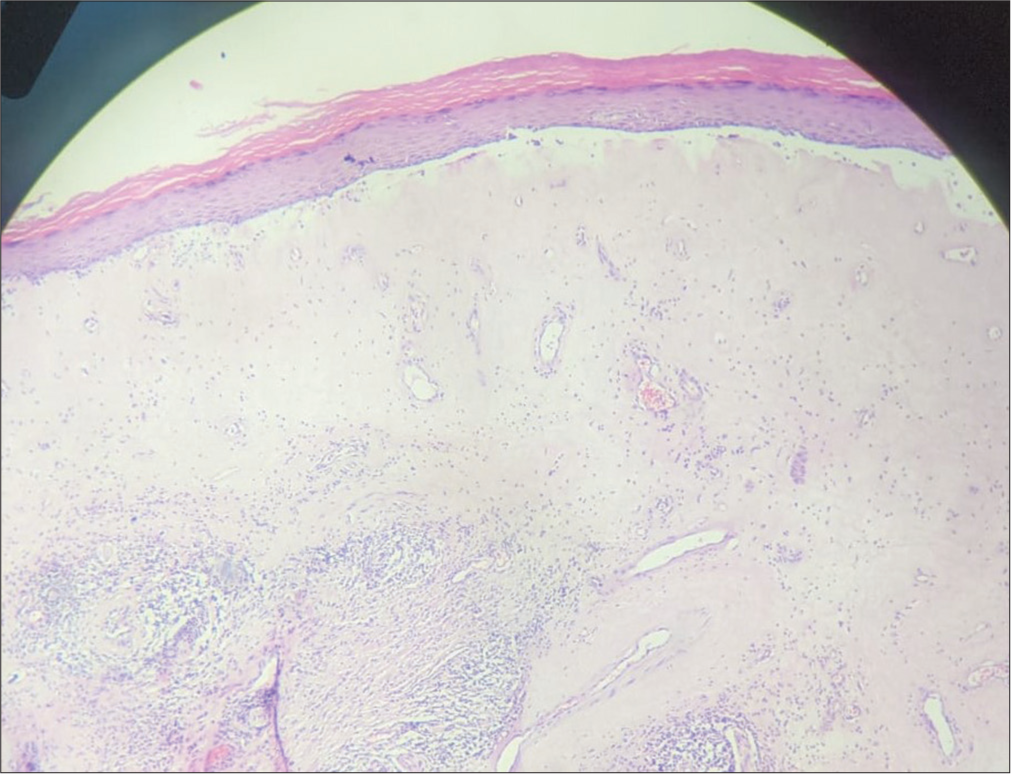 Histopathology showing epidermal thinning, loss of rete ridges, focal basal cell vacuolization, and edema and hyalinization of the papillary dermis (H&E ×40). H&E: Hematoxylin and eosin.