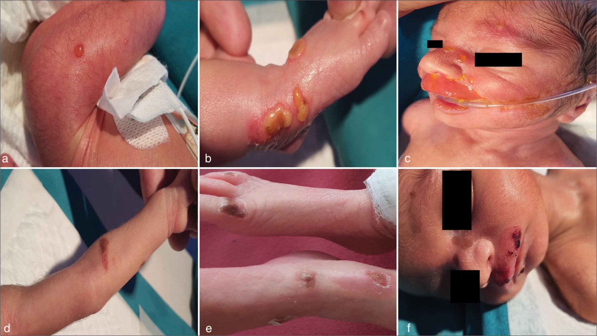 Pre- and post- intravenous immunoglobulin (IVIG) images of neonatal pemphigus vulgaris lesions (a) Neonate presenting with multiple blisters on the left thigh and (b) left foot. (c) Worsening lesions involving the nose, upper lip, and oral mucosa. (d) Healed arm lesions on day 10 post-birth, (e) healed lesions on bilateral feet, and (f) healed facial lesions following IVIG therapy.