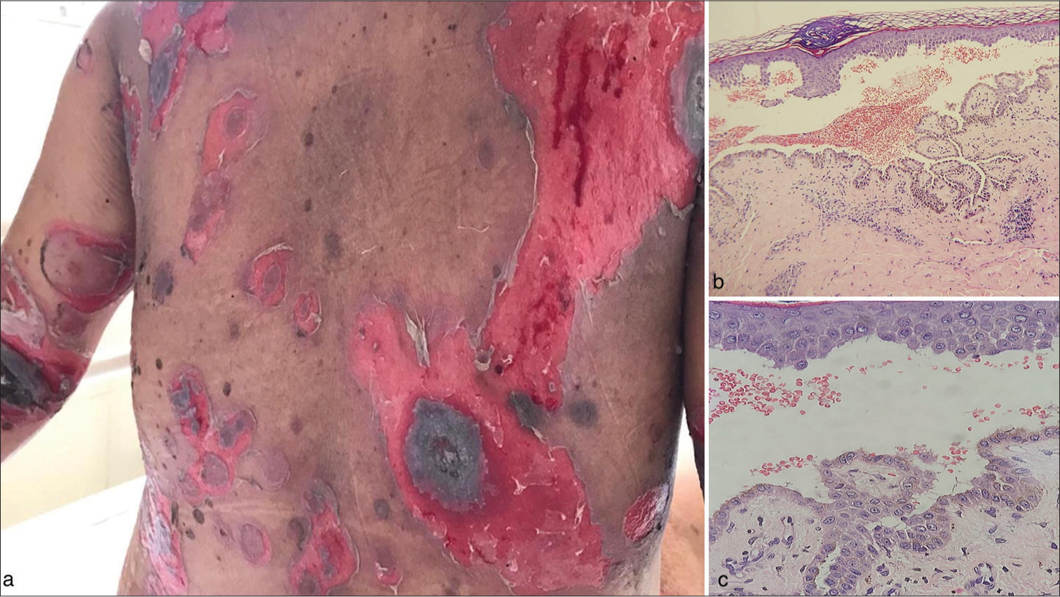 Clinical and histopathological findings in the postpartum mother with pemphigus vulgaris. (a) Multiple erosions with brown-black crusting and blisters over the trunk in the postpartum mother. (b) Histopathology of a skin lesion showing a suprabasal blister with acantholysis and inflammatory cell infiltrates (H&E, ×200 magnification (c) ×400 magnification). H&E: Hematoxylin and eosin.