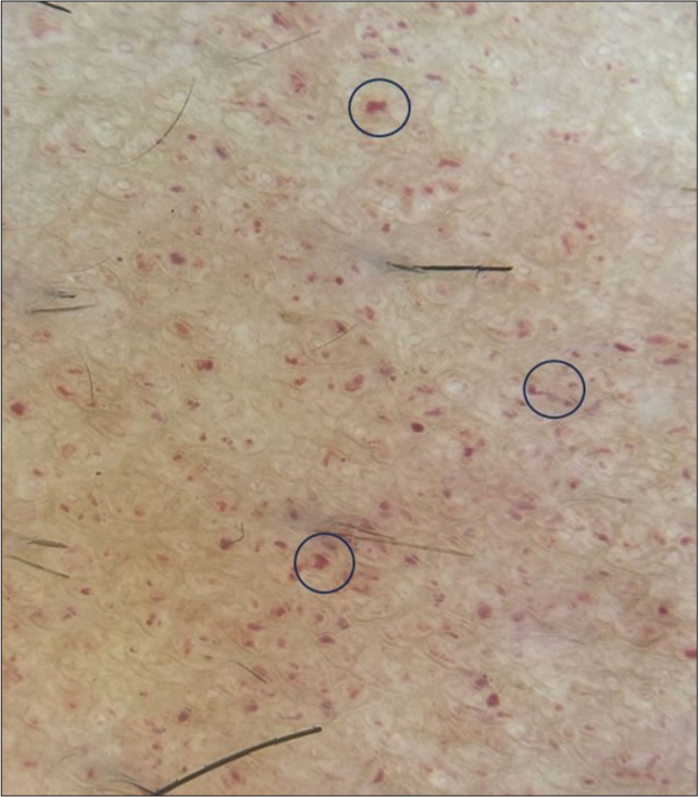 Dermoscopic showing multiple clustered bright red lagoons with peripheral extensions (black circles) [DermLite 3 Gen DL 4, polarized ×10].