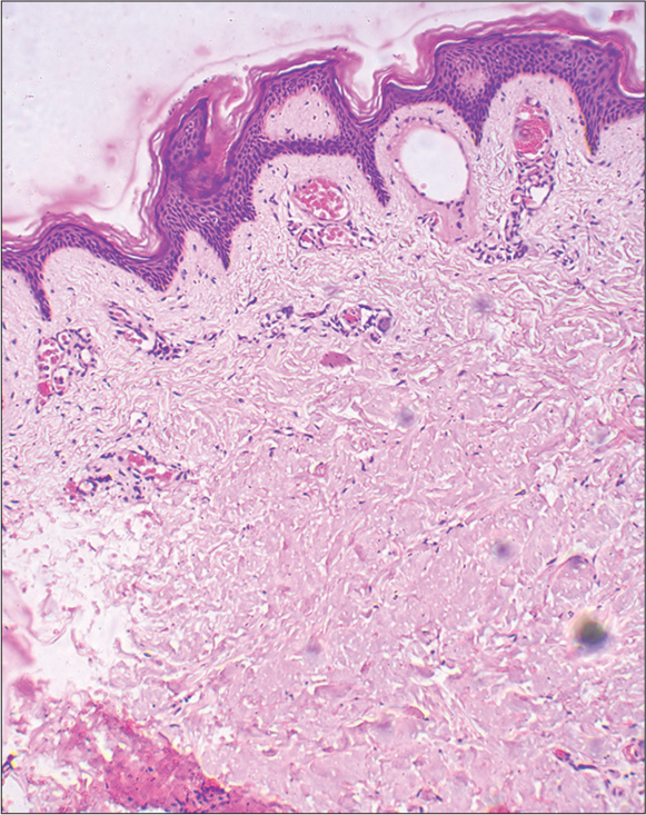 Scanner view of skin biopsy specimen showing dilated thin-walled capillaries in the papillary dermis [H&E, ×40]. H&E: Hematoxylin and eosin.