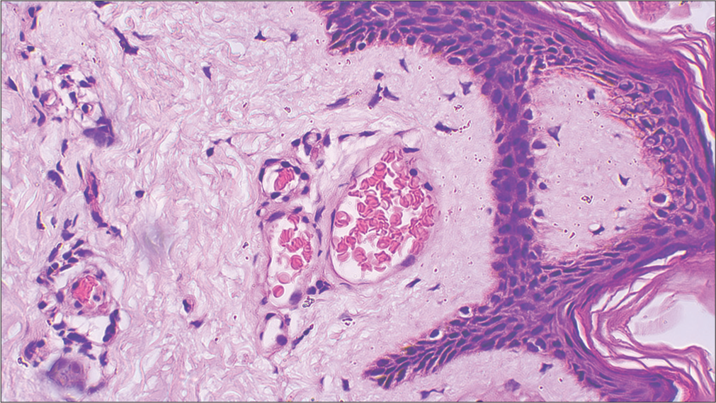 Skin biopsy on higher magnification showing congested capillaries filled with red blood cells with sparse perivascular lymphocytic infiltrate [H&E, ×400]. H&E: Hematoxylin and eosin.