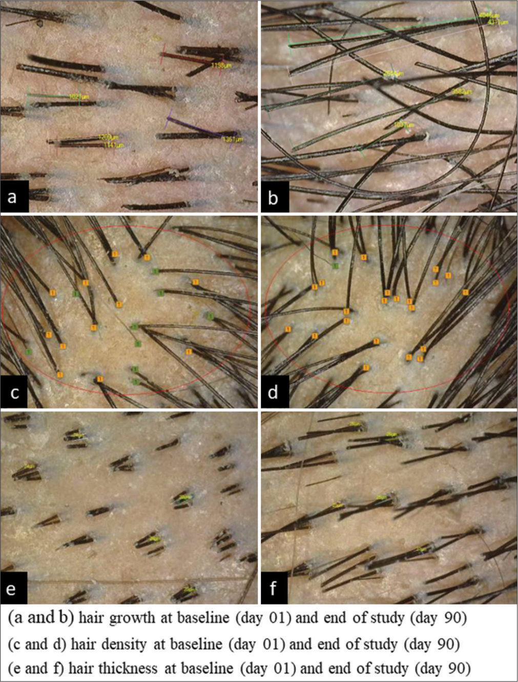 Hair thickness, hair density and hair growth by CASlite nova. (a) CASlite nova images for hair growth. (b) CASlite nova images for hair density. (c) CASlite nova images for hair thickness.