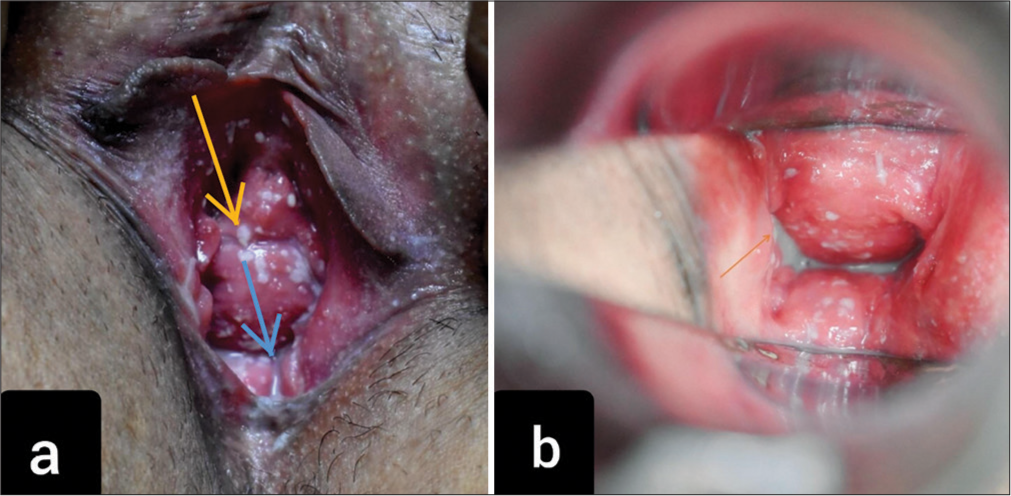 (a) Curdy white discharge in vagina (orange arrow) and thin homogenous white discharge (blue arrow). (b) Copious thin white homogenous discharge in cervix (orange arrow).