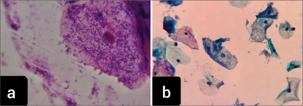 (a) Gram stain: Clue cells (coating of bacteria over vaginal epithelial cells with loss of cellular border) at a magnification of ×1000. (b) Papanicolaou stain: Smear showing clue cells, characteristic of bacterial vaginosis at a magnification of ×400.